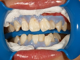 歯面の清掃、歯肉の保護を行い、ジャルを歯面にのせます。02